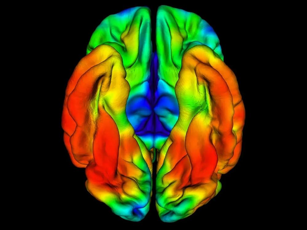  This PET image shows the brain of a Colombian man whose memory and thinking remained intact in his late 60s, even though he carried a rare gene variant that nearly always causes Alzheimer's in a person's 40s.