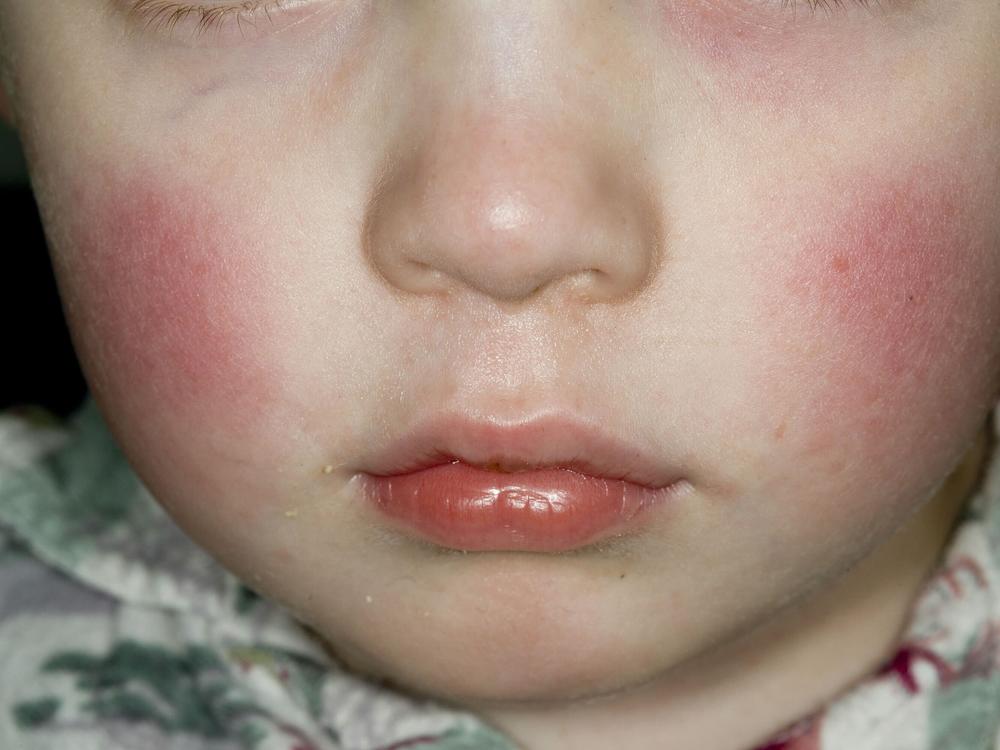 A parvovirus B19 infection can cause a facial rash in children, which is why the disease caused by the virus is sometimes called 