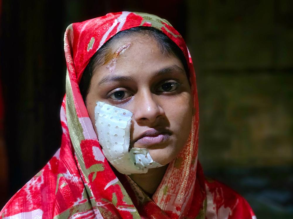 Raashida, 15, says she was injured in her family's home in Rakhine State, Myanmar, on August 7 in a drone attack by the Arakan Army. Her mother and one sibling also sustained injuries. According to Amnesty International, 