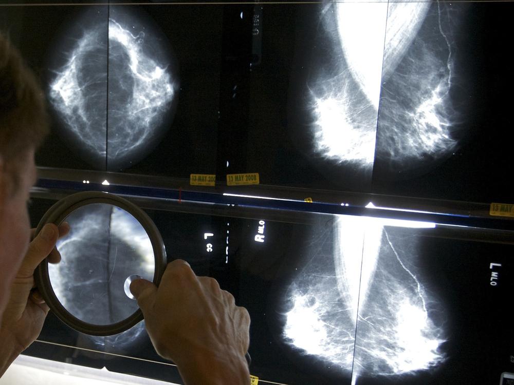 A radiologist uses a magnifying glass to check mammograms for breast cancer.  Breast density is a risk factor for cancer.