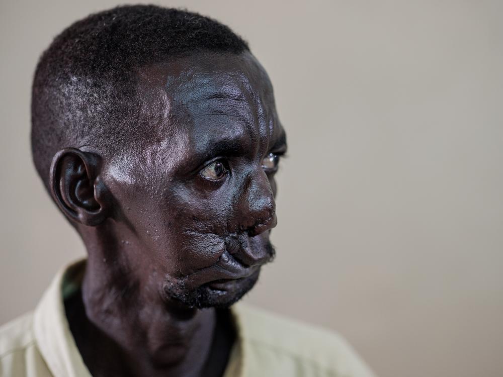 Farata Jadeen received four months of treatment at Al Nao hospital.