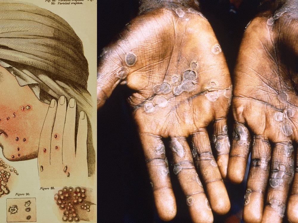 Smallpox and mpox are related diseases — and the eradication of the former inadvertently creating an opening for the latter. At left: An illustration from 1884 depicts smallpox pustules on the face and hand of a woman. At right: A 1997 photograph shows the palms of a woman who contracted mpox during an outbreak in the Democratic Republic of Congo.<br>