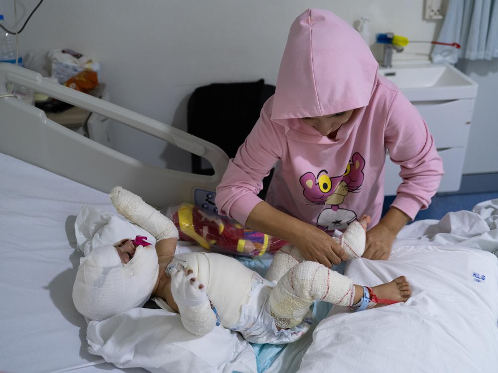 Ivana Likbiri, an 18-month-old Lebanese baby who got injured during an Israeli airstrike in southern Lebanon, is hospitalized at Geitaoui Hospital's burn unit, in Beirut, on Oct. 18.