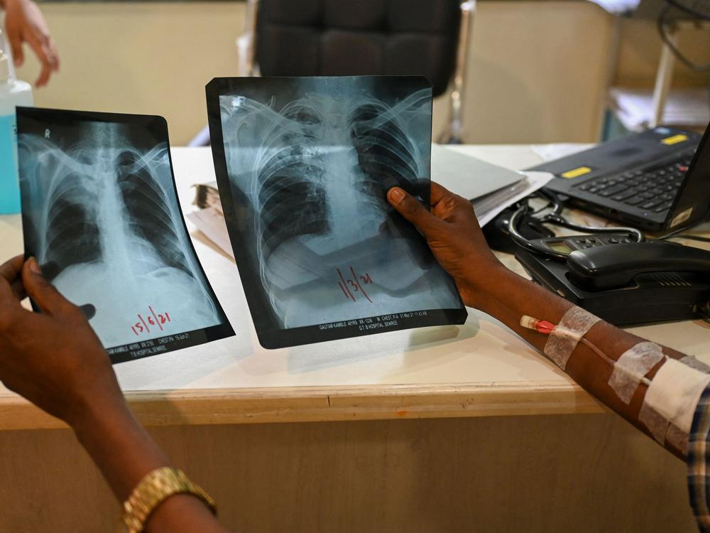 A patient who was diagnosed with tuberculosis holds his chest x-rays while consulting with a doctor at the Médecins Sans Frontières clinic in Mumbai, which treats people with drug-resistant tuberculosis.
