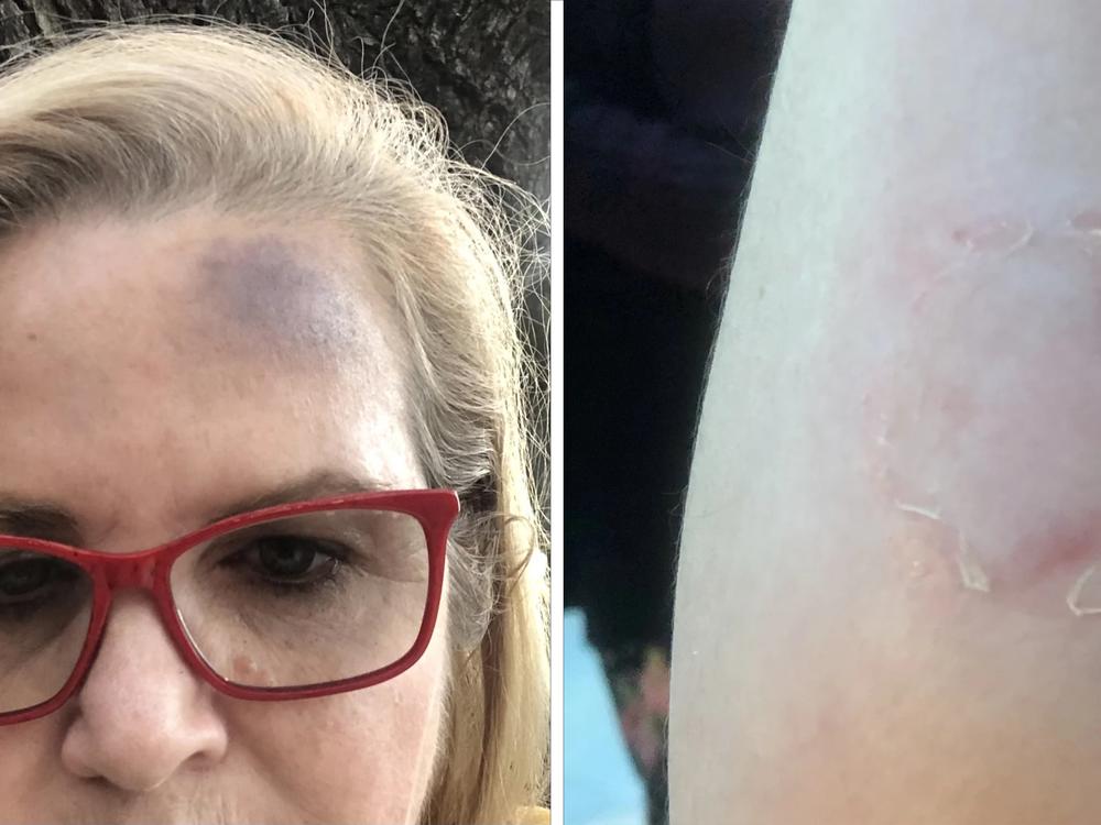 Kreusel has documented her injuries in photos. 