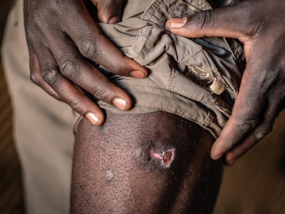 Bernard Muyondo, 34, displays one of several wounds he sustained during a recent elephant attack in the village of Simoonga, outside Livingstone. The attack left him unconscious and bleeding heavily.