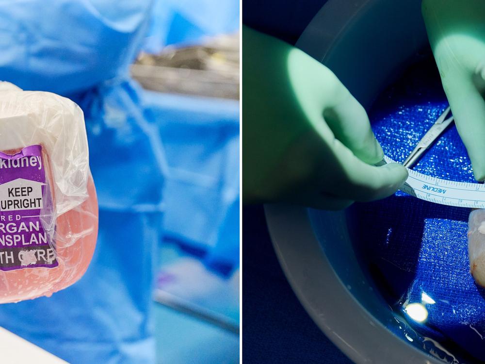A surgical team flew to Revivicor's research farm in rural Virginia and brought back two pig kidneys. Right: Surgeons measure one of the genetically modified pig kidneys before transplanted it into Towana Looney. Left: Surgeons carefully carry one kidney to Towana Looney so they can attach the organ to her blood supply and bladder.