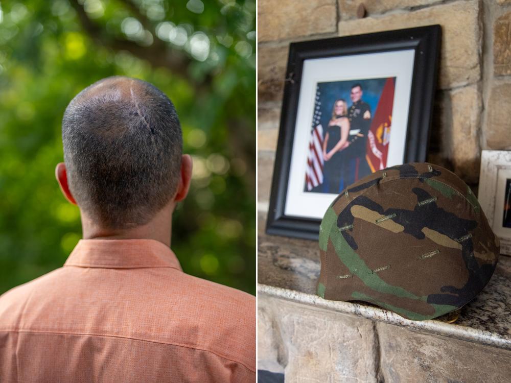 During William Wilcox's service in the Marines, he fired heavy weapons, including shoulder-mounted missile launchers. The blast waves from those weapons may have led to an arteriovenous malformation (AVM) in his brain. As a result of the malformation and subsequent surgery, he now has epilepsy, memory problems, and other symptoms.