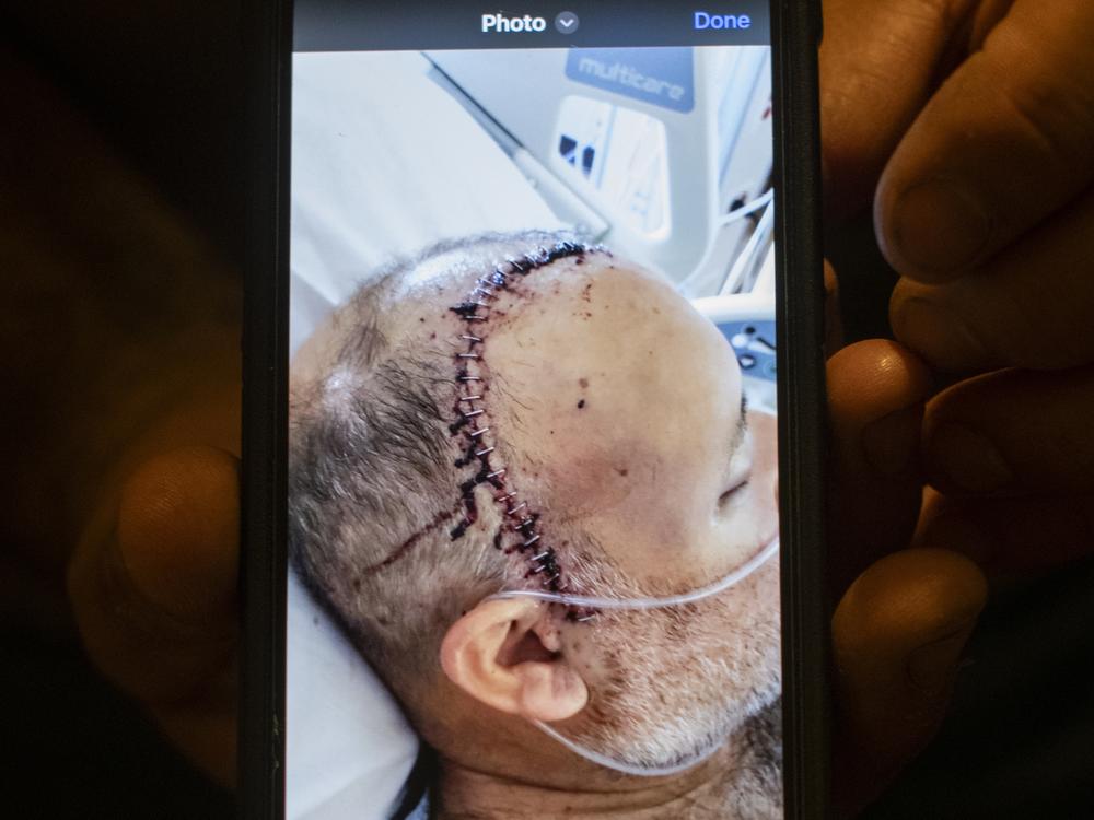 Michael Lozano displays a photo of himself after his surgery.