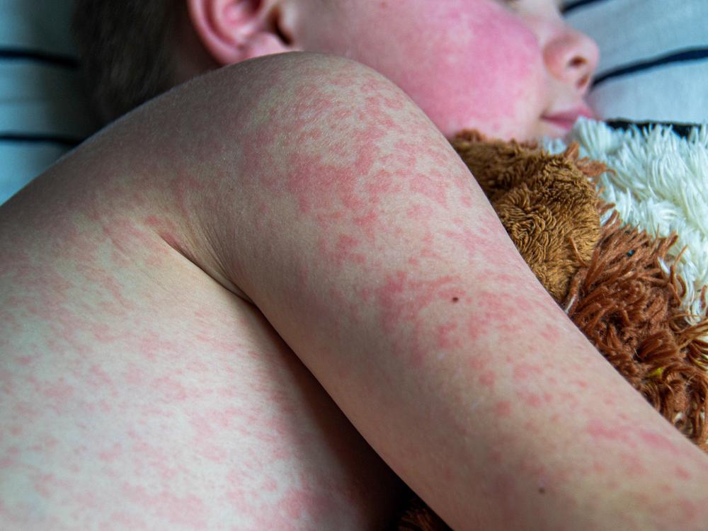 Measles kills thousands of children across the globe every year.