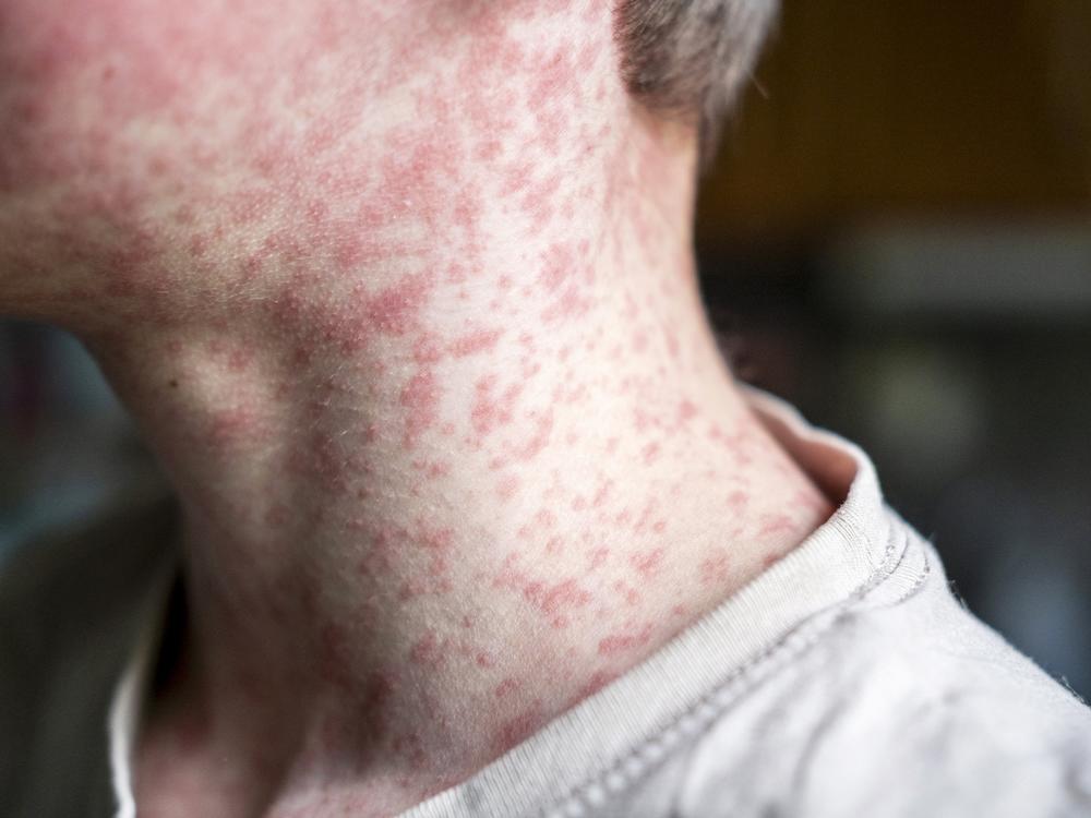 Measles spreads easily. It's one of the world's most contagious diseases.