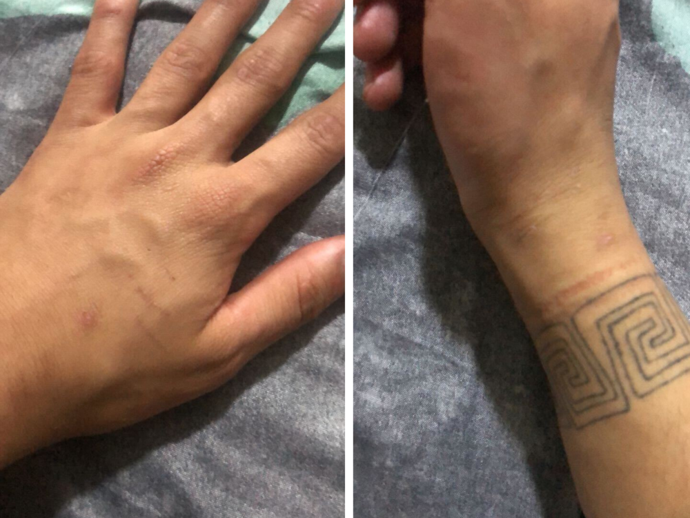 Durán Arapé provided NPR with photos of his wrists that show bruising, as well as injuries on his hands and knuckles.