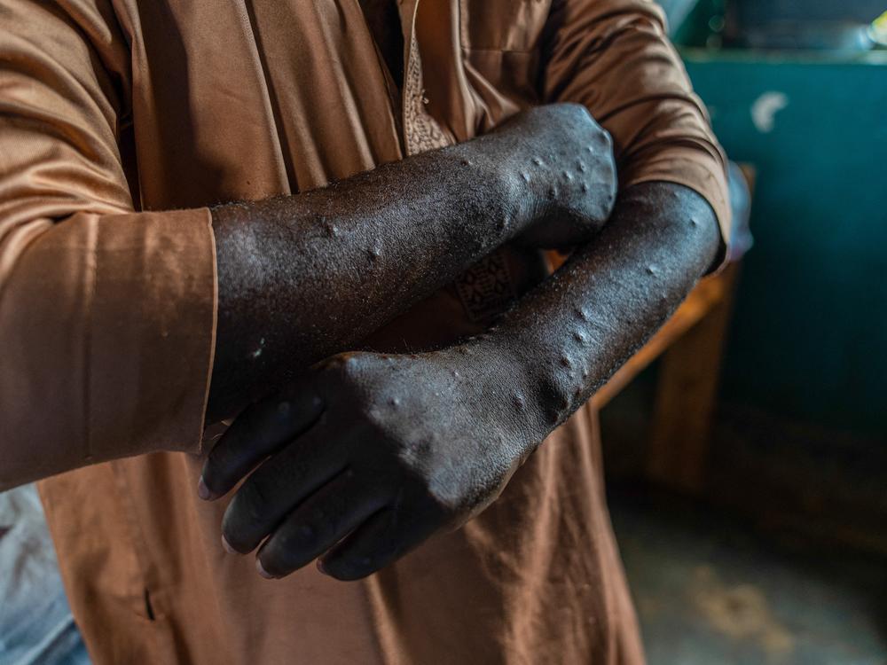 Lesions can be seen on this mpox patient in the Democratic Republic of Congo, the epicenter of an outbreak in Africa.