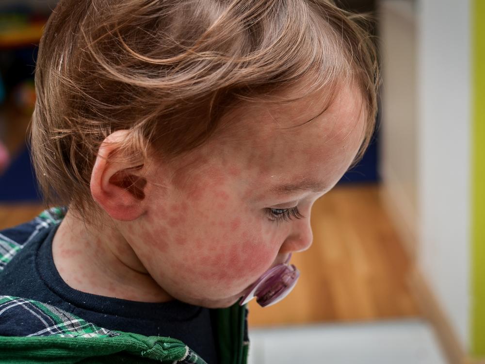Most kids recover from measles. But the virus can be deadly and can erase the immune system's memory.