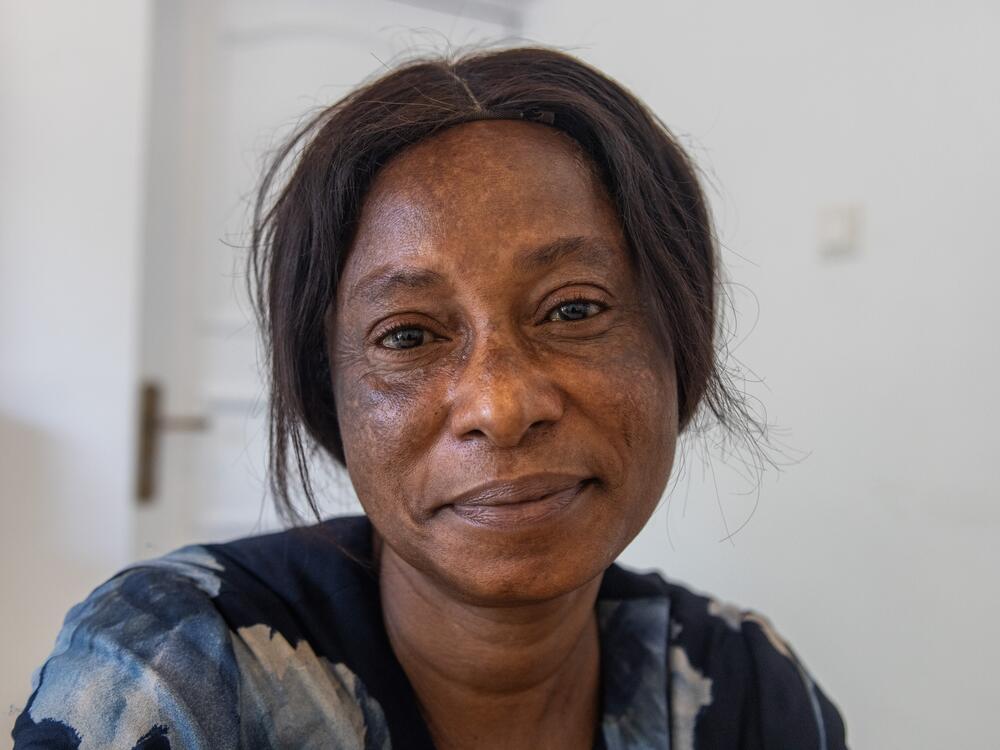 Susan Anderson began using skin lightening creams at age 12. Now 52, she has stopped using the products but her skin shows the damage they caused.