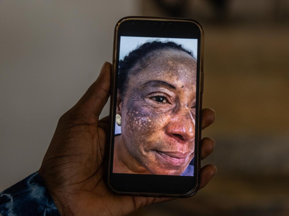 This phone photograph depicts Susan Anderson's skin after decades of using lightening products — and before she began treatment to repair the damage