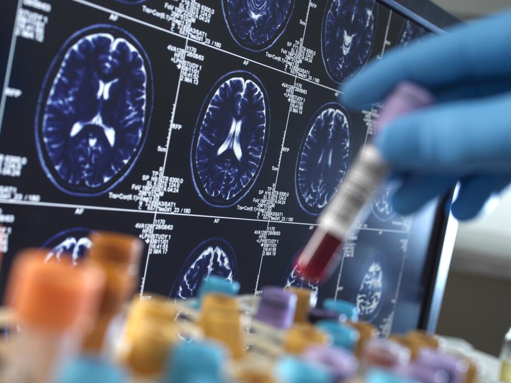 New tests of blood and spinal fluid could help doctors quickly identify patients who would most benefit from treatment.