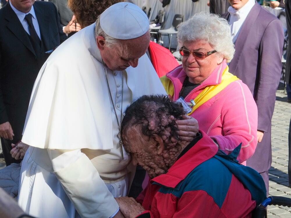 Vatican Pope Francis, general audience Nov. 6, 2013, Pope Francis hug and bless a person sick of neurofibromatosis during the general audience in St. Peter square.