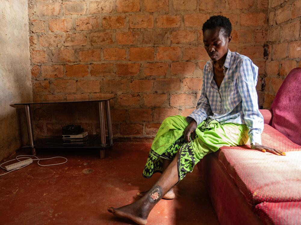 Mary Mayongana, 42, is unsure whether her ankle sore is a result of going off her HIV medications. She says that the pain along with the fatigue she now feels are going to make it hard to walk for 45 minutes to reach the nearest clinic after the closure of the U.S.-funded clinic she had previously used.