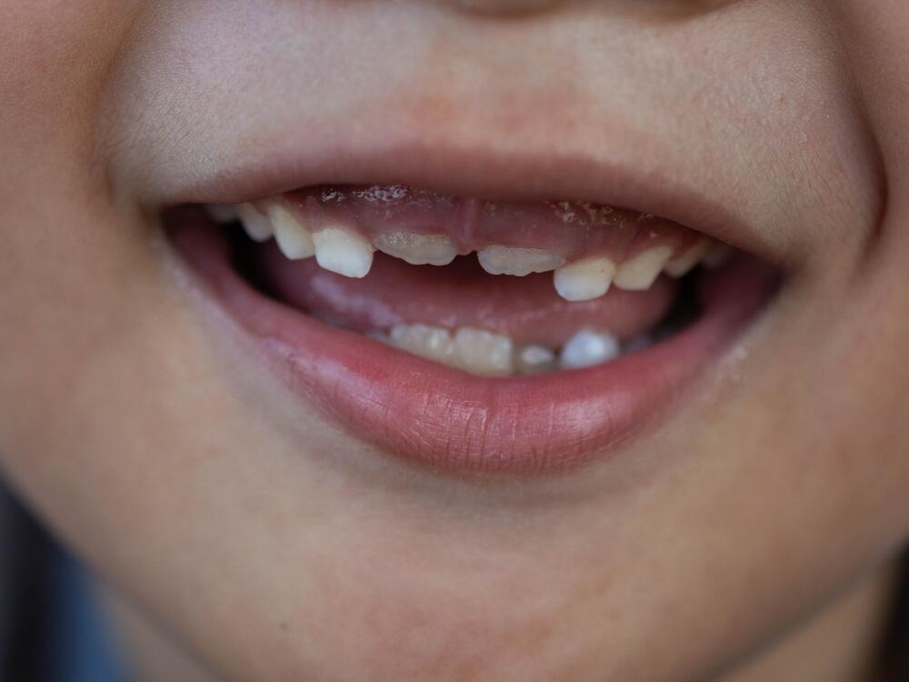 Dentists sometimes prescribe fluoride supplements to kids in areas that lack water fluoridation. FDA is taking action to remove such treatments from the market.