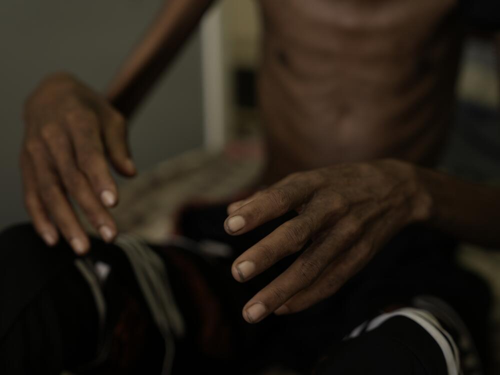 The thin hands and body of 24-year-old Munir Jelabi, who is being treated at a military hospital in Khartoum for conditions caused by severe malnutrition.