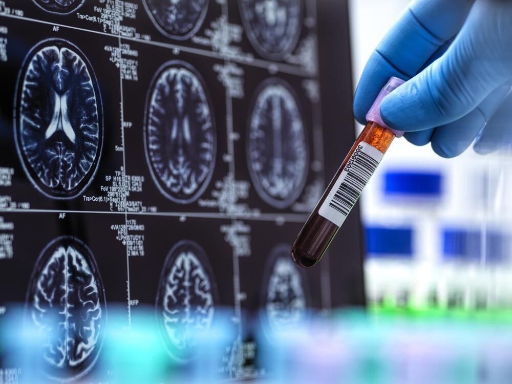 The first Alzheimer's blood test cleared by the Food And Drug Administration is set to make diagnosis more accessible and accurate — and change the way doctors treat the disease.