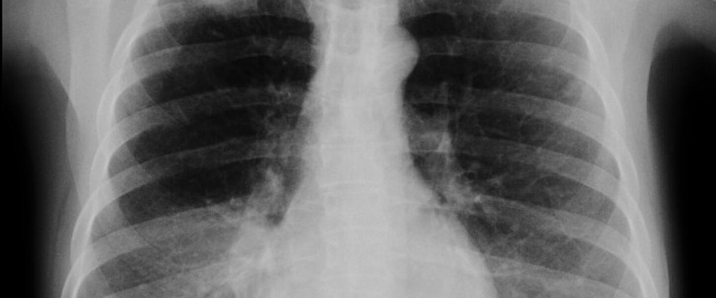 Courtesy, <a href="http://en.wikipedia.org/wiki/Pancoast_tumor" target="_blank">Wikimedia</a> Courtesy, <a href="http://en.wikipedia.org/wiki/Pancoast_tumor" target="_blank">Wikimedia</a>