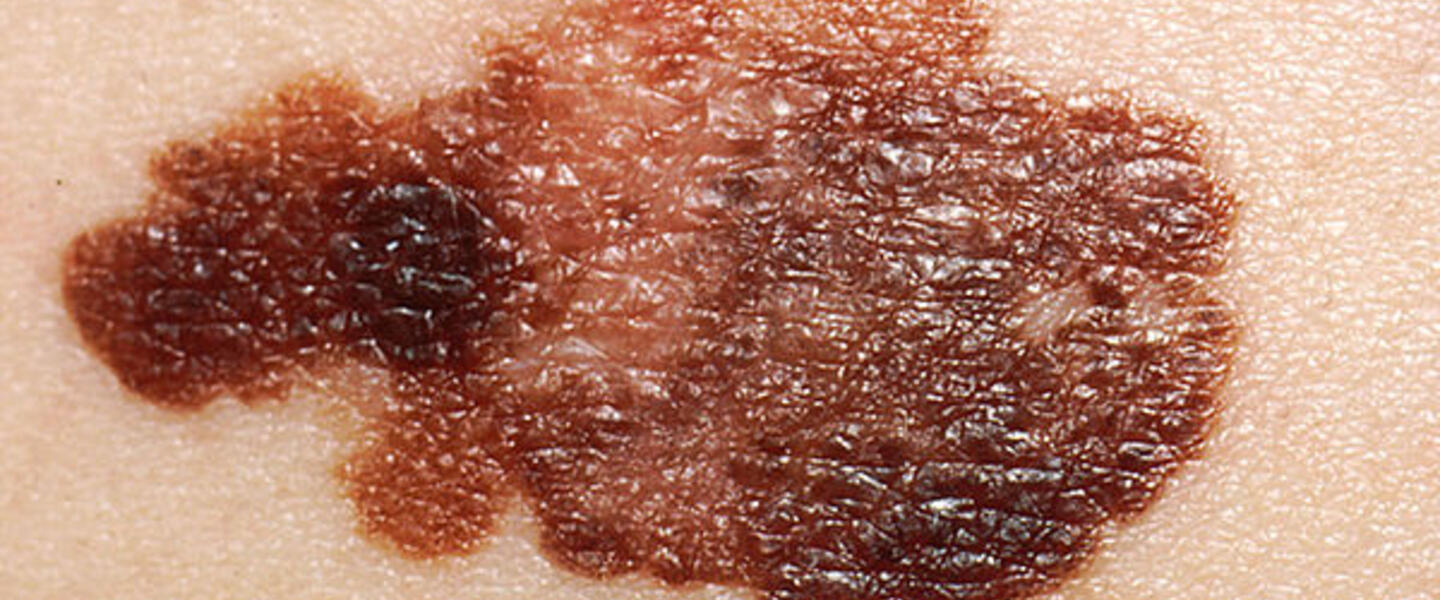 Melanoma, Courtesy, <a href="http://commons.wikimedia.org/wiki/File:Melanoma_(2).jpg" target="_blank"> Wikimedia</a> Melanoma, Courtesy, <a href="http://commons.wikimedia.org/wiki/File:Melanoma_(2).jpg" target="_blank"> Wikimedia</a>