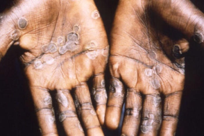 Photo of Monkeypox