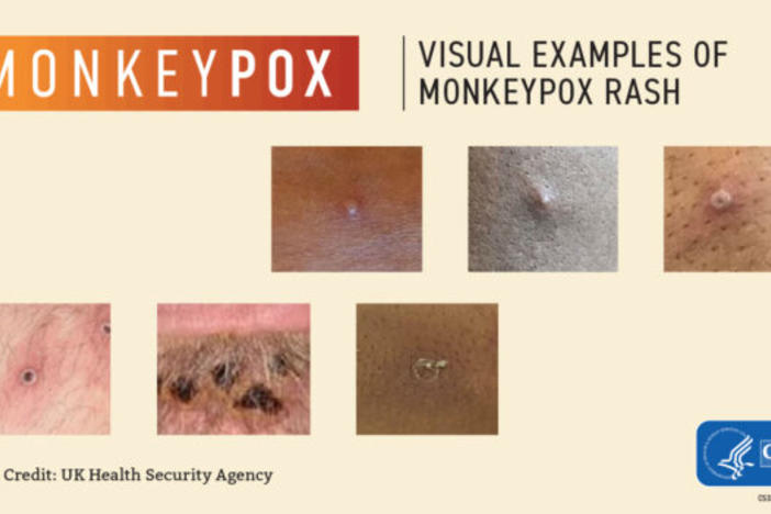 Examples of monkeypox rash on skin