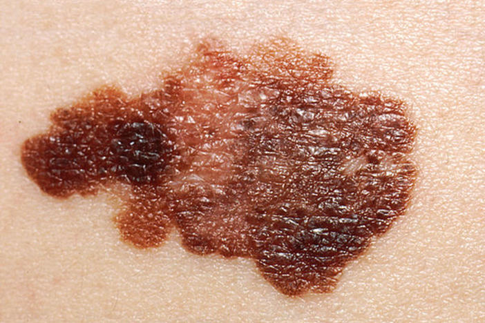 Melanoma, Courtesy, <a href="http://commons.wikimedia.org/wiki/File:Melanoma_(2).jpg" target="_blank"> Wikimedia</a>