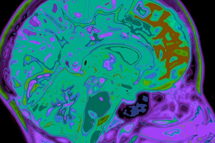 Tangles of a protein called tau inside neurons may be the culprit behind Alzheimer’s.