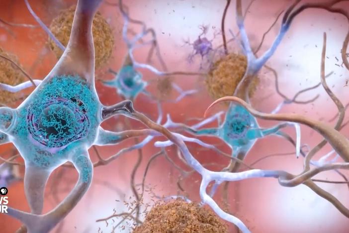 Can ultrasound be used to fight Alzheimer's?