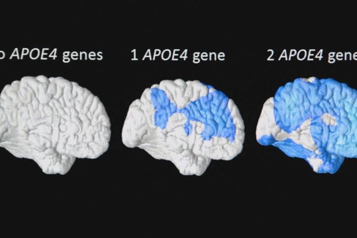 Certain gene forms increase your risk of developing Alzheimer's.