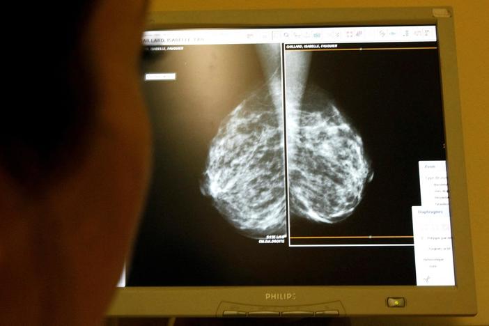 Mammograms should start at 40, task force recommends