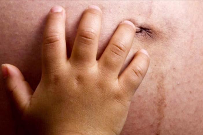 The U.S. has a problem with maternal mortality, especially for women of color.