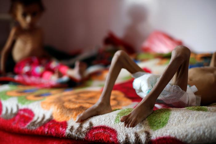 Yemen on brink of catastrophic famine orchestrated by Saudis