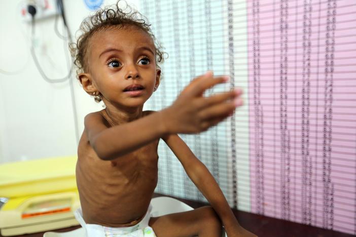 Yemen's war must end to address starvation, UN food aid chief says