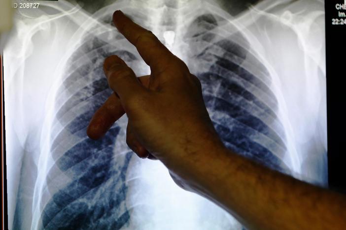 New treatments yield hope for stopping tuberculosis, world's leading infectious killer