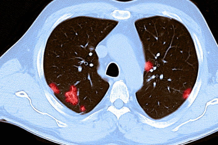A CT scan of the chest of a 66-year-old male reveals patchy rounded hazy spots throughout the lungs. He had tested positive for the coronavirus and experienced shortness of breath.