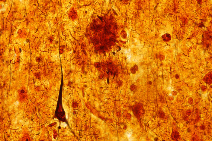 This light micrograph from the brain of someone who died with Alzheimer's disease shows the plaques and neurofibrillary tangles that are typical of the disease. A glitch that prevents healthy cell structures from transitioning from one phase to the next might contribute to the tangles, researchers say.