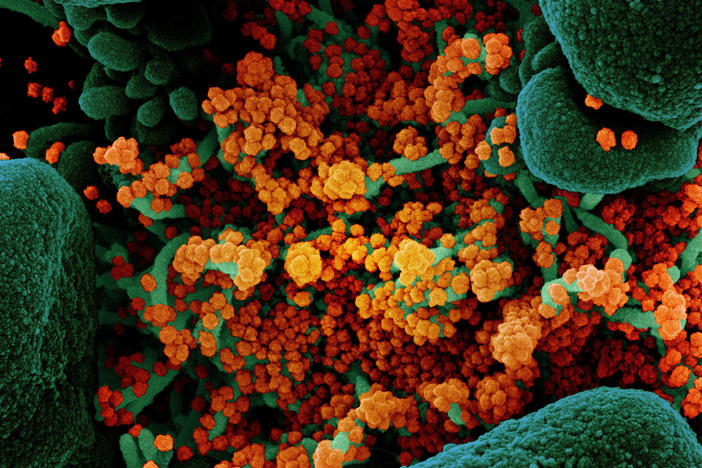 A colorized scanning electron micrograph of a cell (green) heavily infected with particles (orange) from the virus that causes COVID-19, isolated from a patient sample.