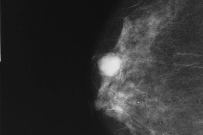 A mammogram of a breast with a whitish area diagnosed as colloid carcinoma.