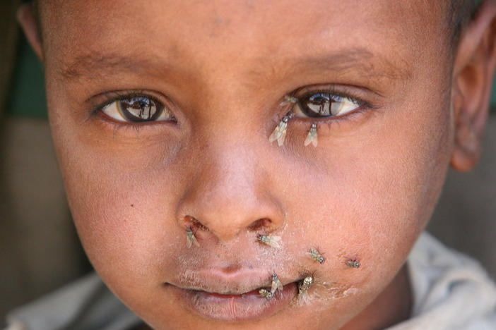 Trachoma, caused by a micro-organism, is highly contagious, spread by eye-seeking flies and through contact with the eye discharge of an infected person. Children and women are most susceptible to the infection.