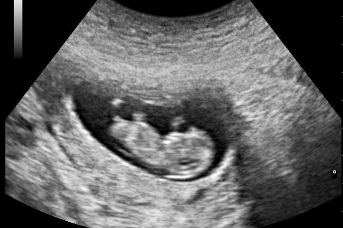 Looming Georgia state budget cuts has Morehouse School of Medicine re-evaluating how to fund its Center for Excellence on Maternal Mortality.