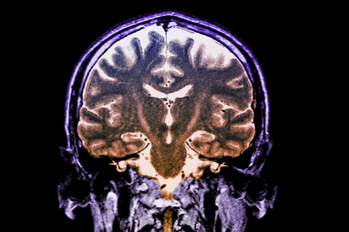 Patients with a fast-progressing form of ALS who got daily doses of an experimental two-drug combination called AMX0035 scored higher on a standard measure of function than patients who didn't get the drug.