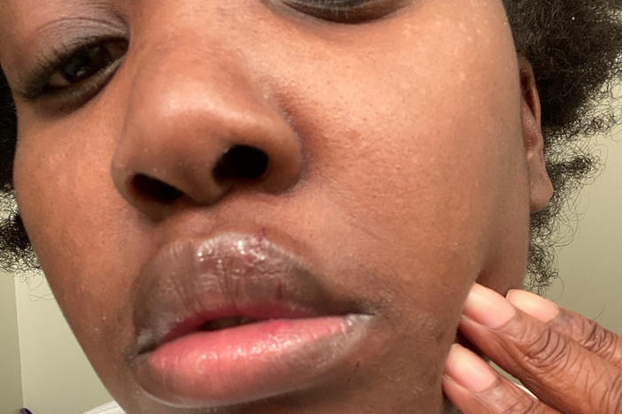 This undated selfie photo provided by Rickia Young shows her lip. Attorney Kevin Mincey, who represents Young, says she went to retrieve her 16-year-old nephew from the area were a protest was occurring, and put her 2-year-old son in the car to help him fall asleep.