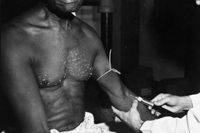 A participant in the Tuskegee Study in the 1930s. A lingering mistrust of the medical system among many Black people is rooted in the infamous study.