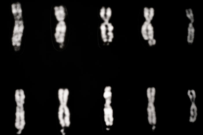 Fragile X syndrome involves changes in the X chromosome, as pictured in the four columns of chromosomes starting on the left. The fifth column, on the far right, shows two normal X chromosomes.