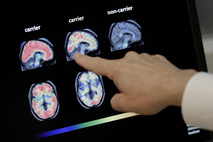 Dr. William Burke reviews a PET brain scan at Banner Alzheimer's Institute in Phoenix in 2018. An experimental Alzheimer's drug from Biogen and Eisai is on the verge of a Food and Drug Administration decision.